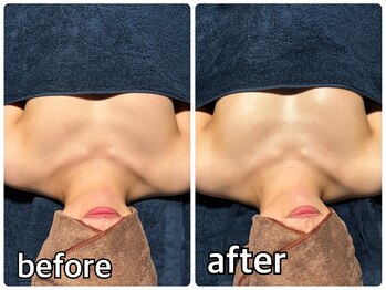 リルマコ/バスト症例写真