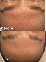 命の洗濯/１０ヶ月/シミや毛穴も綺麗に