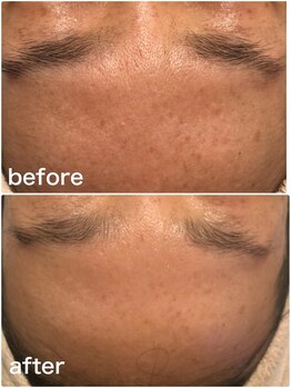 命の洗濯/１０ヶ月/シミや毛穴も綺麗に