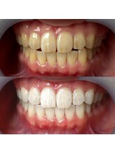 ワールドビューティー(World Beauty)/30代女性/ホワイトニング　6回