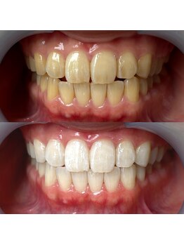 ワールドビューティー(World Beauty)/30代女性/ホワイトニング　6回