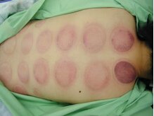 整体院もみのき 土浦本店/吸い玉（カッピング）2