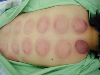 整体院もみのき 土浦本店/吸い玉（カッピング）2