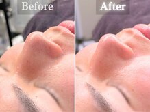 ボーンオム(Born Homme)/毛穴洗浄＋美容液導入：20代男性