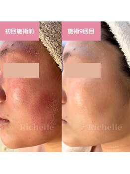 リシェル(Richelle)/ 【GREENPEELセンシダーム】