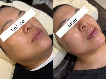 ウィズルーチェ 神栖店(with luce)/小顔１回効果★むくみ二重顎撲滅