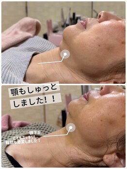 イズビューティー 足利(is Beauty)/レモンボトル