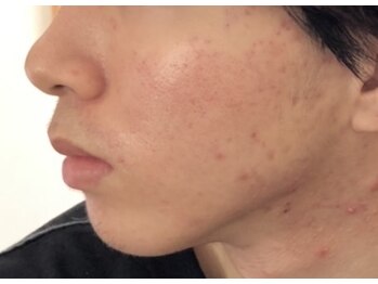 オアシスラグーン(OASIS LAGOON)/ニキビケア(症例2:after)
