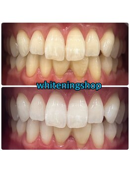 ホワイトニングショップ 八重瀬店/【ビフォーアフター】美白