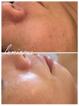 ルミナス(luminous)/【ハーブエステ】グリーンピール