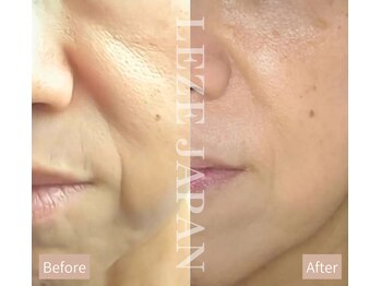 ルーナ 恵比寿(Luna)/肌別ピーリングはたるみにも効果