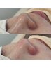 【毛穴黒ずみ・角栓集中コース】毛穴吸引+毛穴を小さく!肌キメ改善