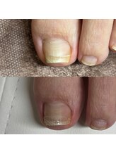 リリ(lili)/巻き爪矯正1回目（左親指）