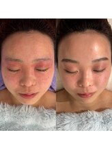 ラテプラス(LATEE＋)/赤みや熱感【30代】