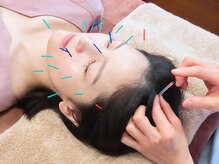 コハル鍼灸整骨院 本郷三丁目(COHARU鍼灸整骨院)/施術風景☆美容鍼・小顔