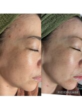 ラズ(Luz)/雪花ピール