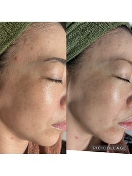 ラズ(Luz)/雪花ピール