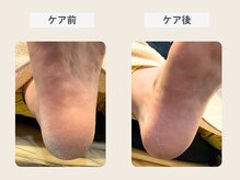 ルポ 伊勢/かかと角質ケア