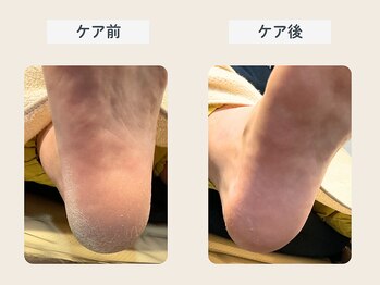 ルポ 伊勢/かかと角質ケア