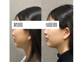 リエイト(Re:eight)/マイクロウェーブリフト5回施術