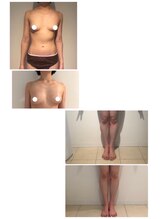 美人バスト 札幌店/ダイエット◇症例◇バストアップ