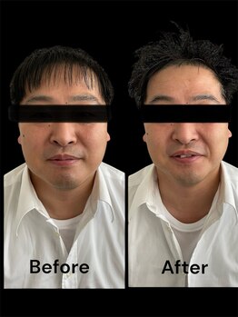 ブライトプラス(BRIGHT+)/ハイドロ毛穴洗浄+小顔ケア