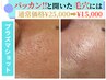 【ぱっかーんと開いた毛穴の引き締め◎】その場で実感！リピート価格あり