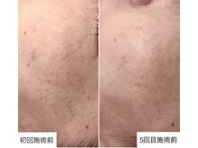 オリエンタルビューティー(ORIENTAL BEAUTY)/光フェイシャル