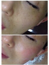 サンテボーテ(Sante Beaute)/ハーブピーリング　５回目