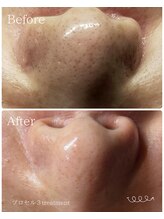 レア(le'a)/鼻の毛穴