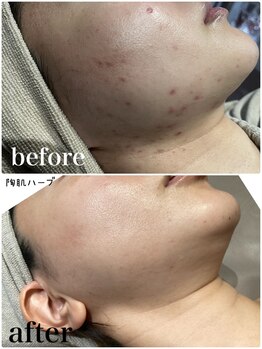 ニコ(nico)/肌質改善Before→after