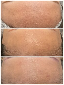 トリアングル(TLIENGLE)/ララピール before after