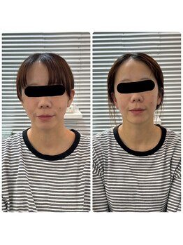 陽月 鍼灸院整骨院/美容鍼モニター