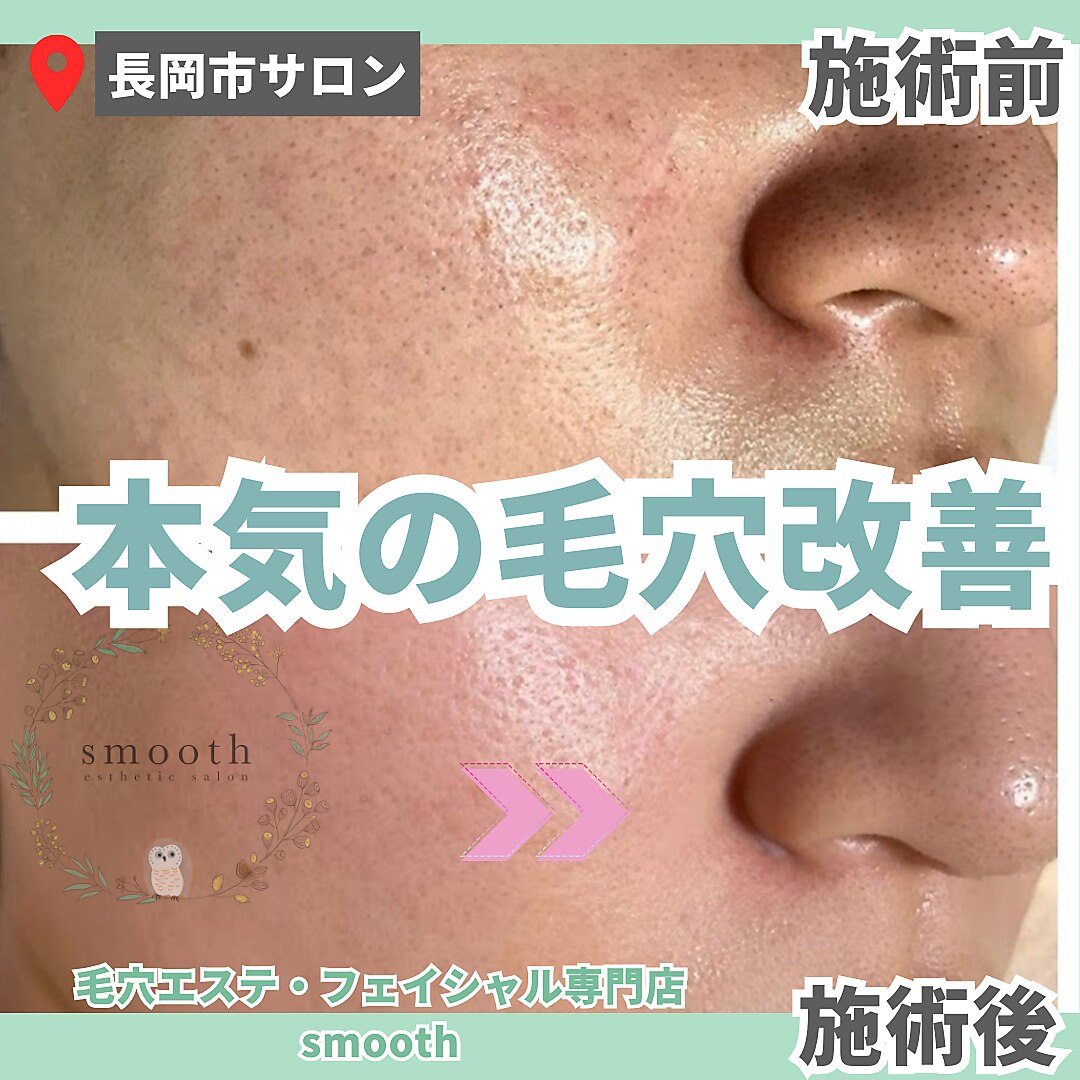 毛穴エステ 込900円 ニキビ、毛穴、、ご自分では改善出来ないお悩みはCP SALON SURF