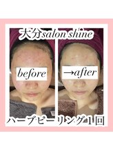 サロンシャイン(Salon Shine)/ハードハーブピーリング１回