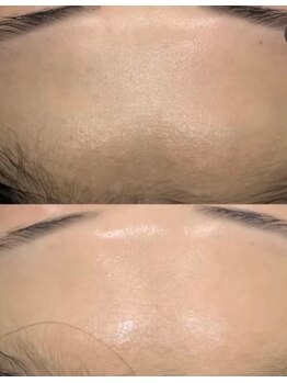 エイシスグロウ(asis glow.)/ララピール 効果写真