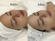 リフコウベ(LIF KOBE)/シミ・美白・炭酸ピーリング1回