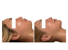 インディバ＋マッサージで燃焼☆痩身にも効果的☆