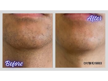 リボーン(Re bone)/メンズ脱毛にも対応★