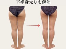 トレゾール(tresor)/【痩身】セルライト撃退（-６cm)