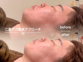 ソワン ド ブランシュ ライフ八戸ノ里店(Soin de Blanche)/輪郭のたるみ・むくみ改善