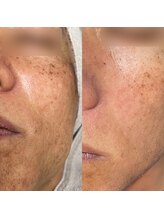 エムズビューティー(M’s Beauty)/ハーブピーリング1回目のお客様