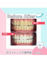 エクシアホワイトニング 札幌中島公園店/BeforeAfter［ホワイトニング］ 