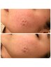 【乳酸菌ピーリング】シワ・シミに悩まれてる方へ