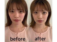 マホロバ(mahoroba)/美容鍼ビフォーアフター