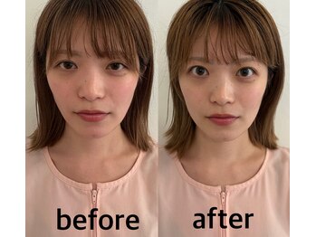 マホロバ(mahoroba)/美容鍼ビフォーアフター