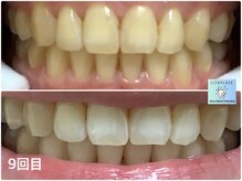 リタプレイス 琴似(LITAPLACE)の雰囲気（輝く白い歯でマイナス５歳を目指しませんか？当日予約大歓迎♪）
