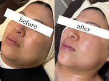 ウィズルーチェ 神栖店(with luce)/小顔１回効果★むくみ二重顎撲滅