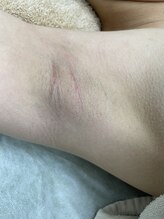 ナノハナ/鹿沼市の全身脱毛のナノハナ