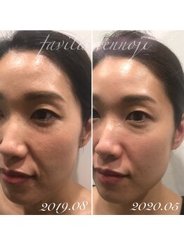 ファビリス 天王寺店(FAVILIS)/リアボーテ化粧品1年使用結果